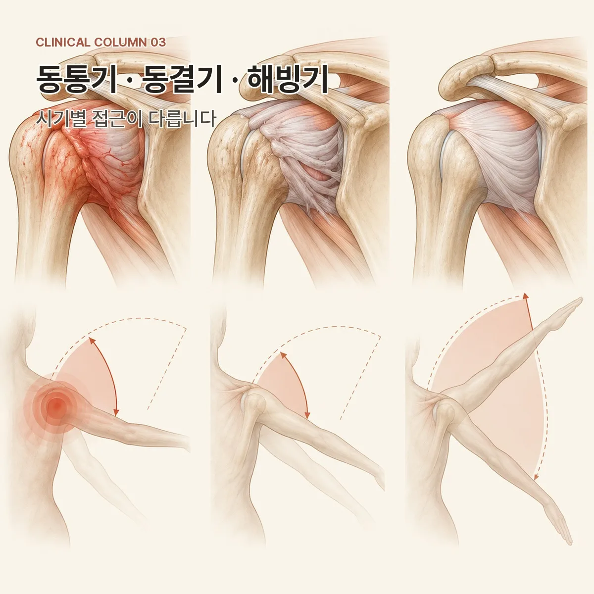 오십견의 동통기 동결기 해빙기 경과