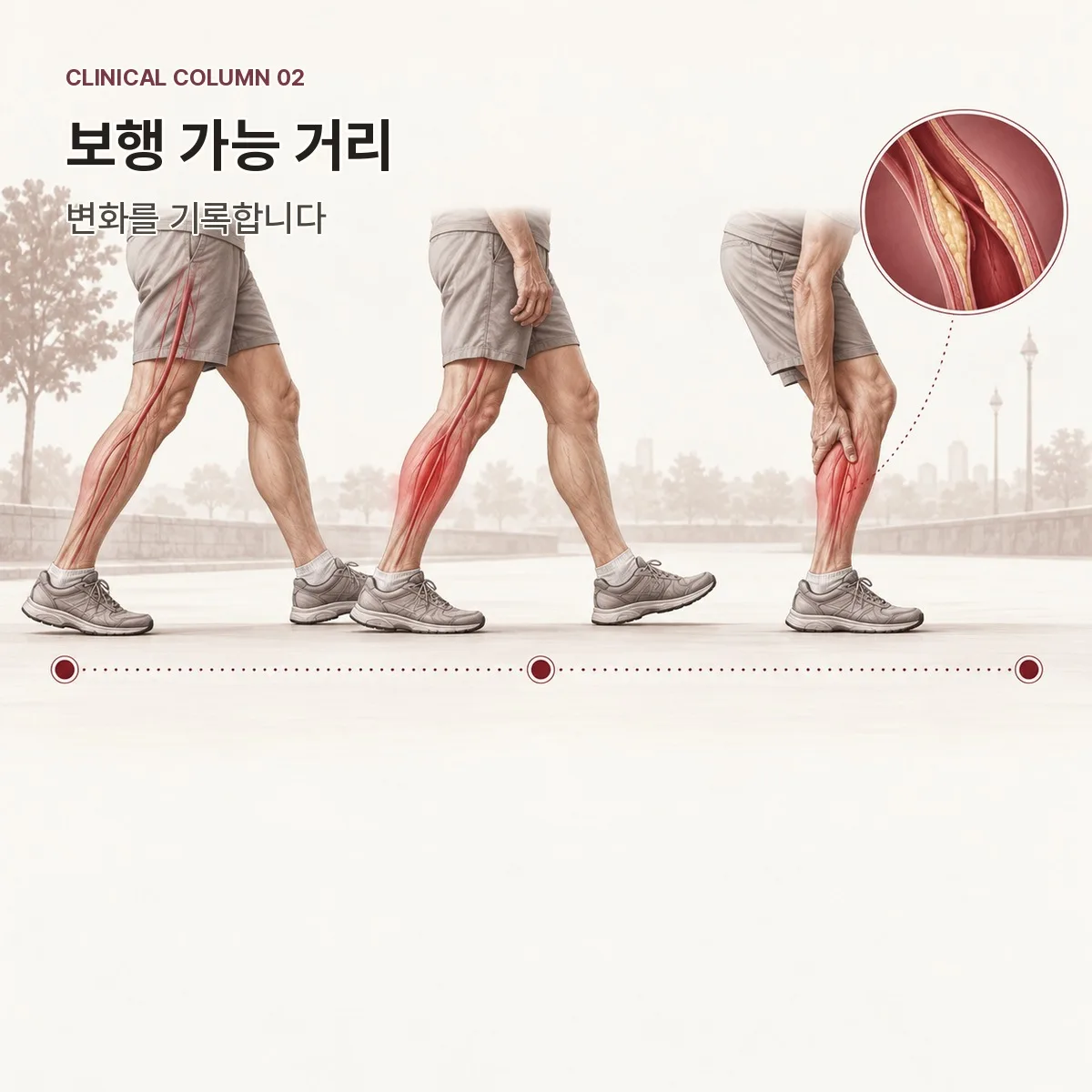 간헐적 파행의 보행 거리 측정과 기록