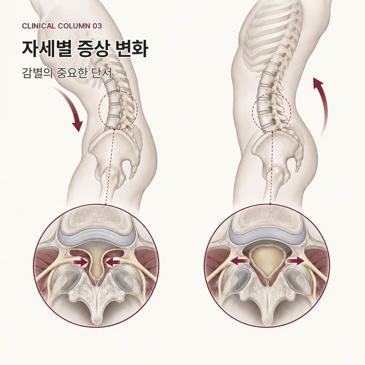 자세별 증상 변화를 통한 협착증 감별
